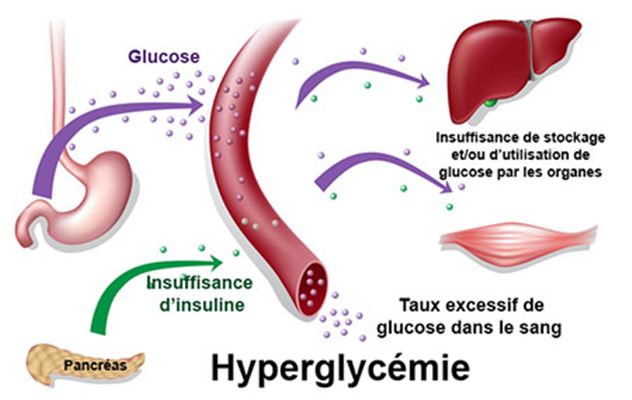 Hyperglycémie