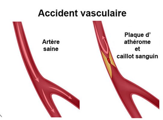 Accidents vasculaires