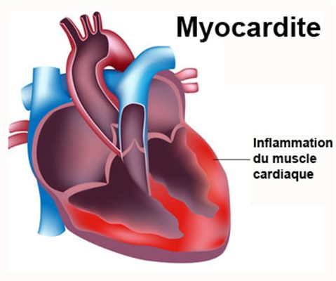 Myocardite