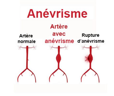 Anévrisme de l'aorte abdominale :  des réponses à vos questions