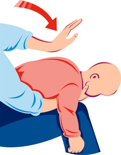 Manoeuvre de Mofenson (enfant de moins de 2 ans)