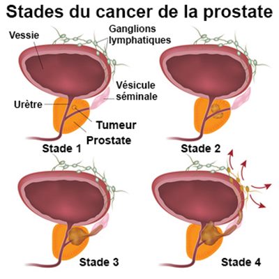 Cancer de la prostate