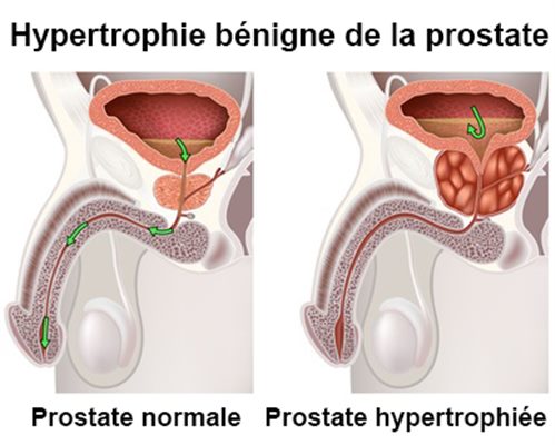 Adénome de la prostate