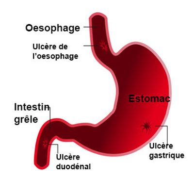 Maladies de l'estomac