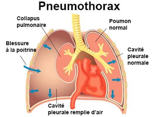 Pneumothorax