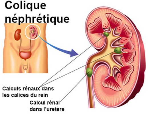 Colique néphrétique