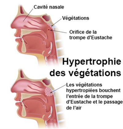 Opération des végétations