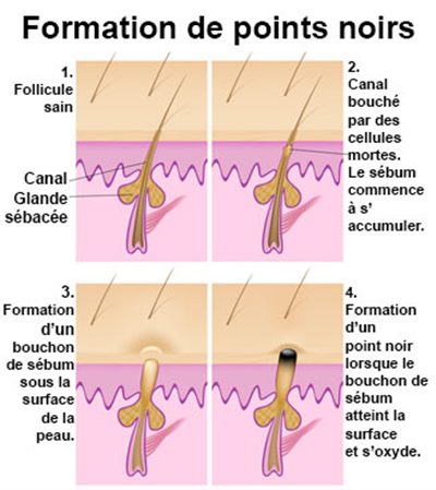 Points noirs