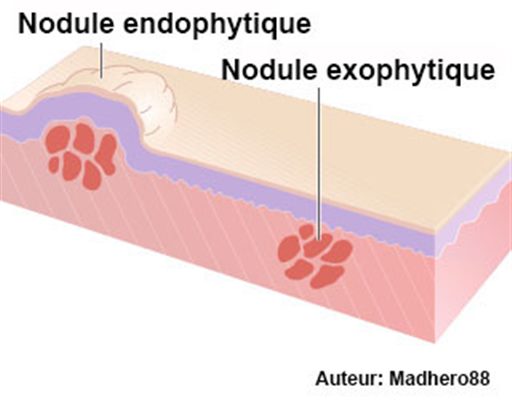 Nodules cutanés