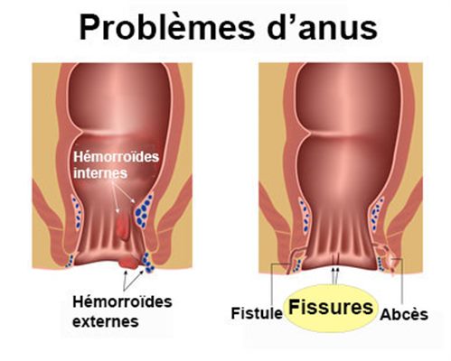 Fissure anale