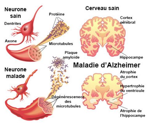 Signes de la maladie d'Alzheimer