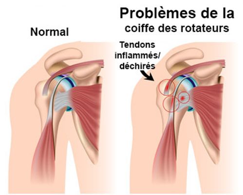 Tendinite de l'épaule