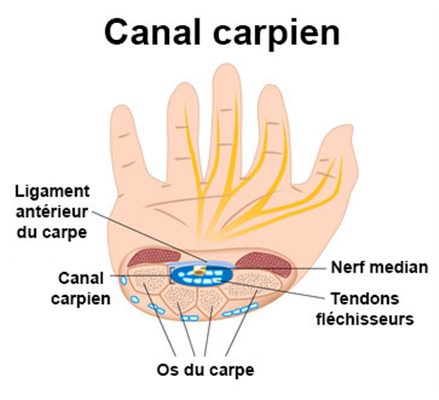 Syndrome du canal carpien