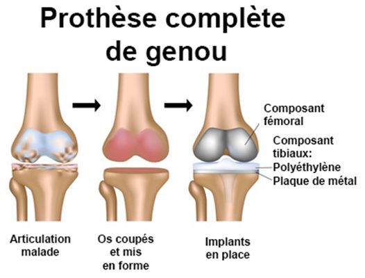 Prothèses articulaires