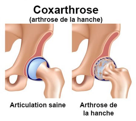 Coxarthrose