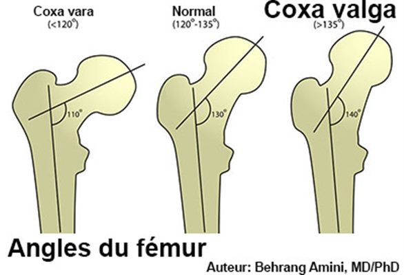 Coxa valga