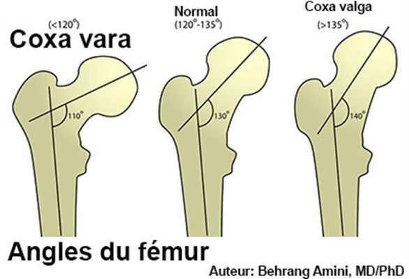 Coxa vara