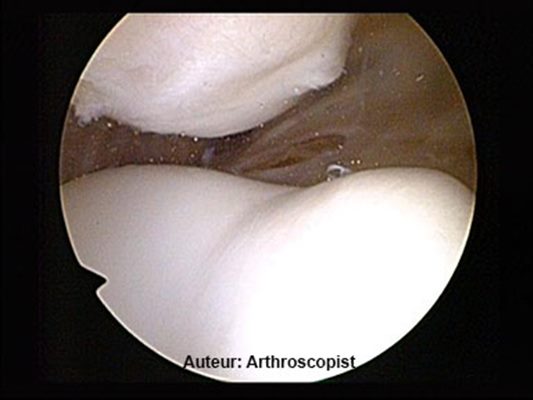 Arthroscopie