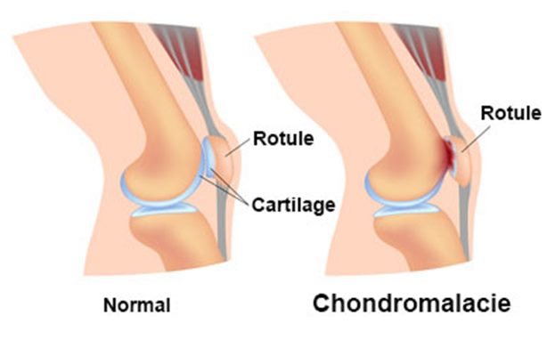 Chondromalacie