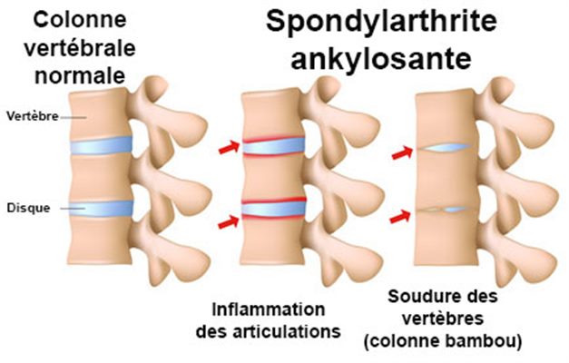 Spondylarthrite ankylosante