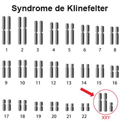 Syndrome de Klinefelter