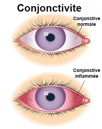 Conjonctivite du nourrisson
