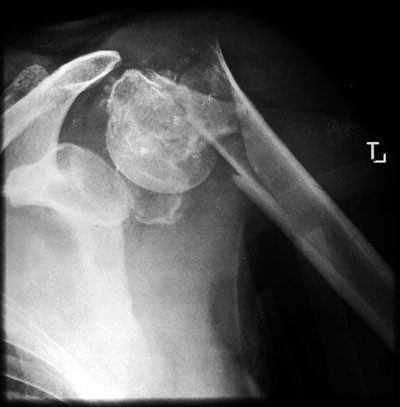 Fracture de l'épaule