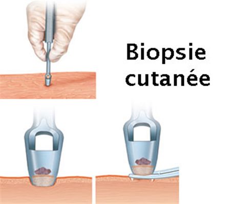 Biopsie cutanée