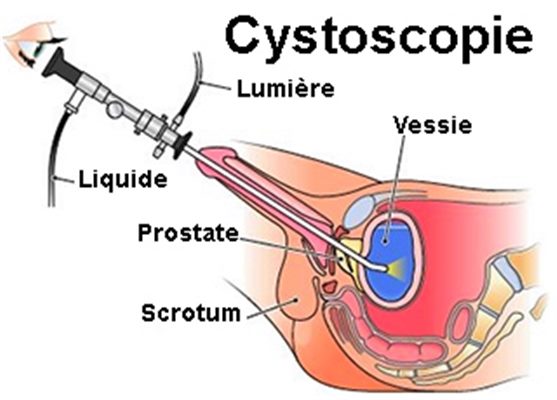 Cystoscopie