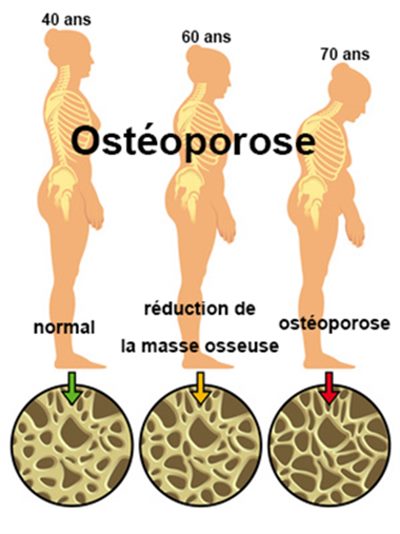 Ostéodensitométrie