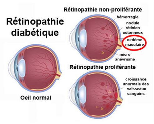 Oedème maculaire
