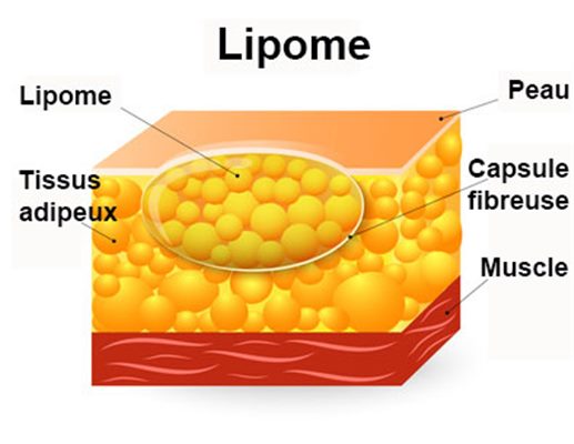 Lipome