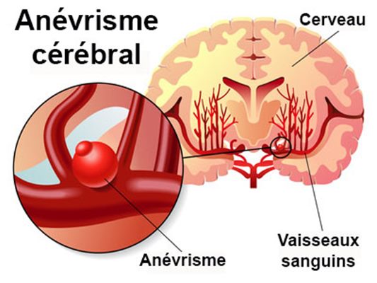 Que faire en cas d'anévrisme cérébral ?