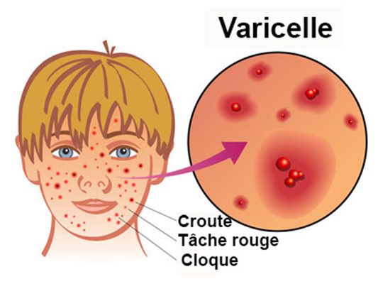 Varicelle