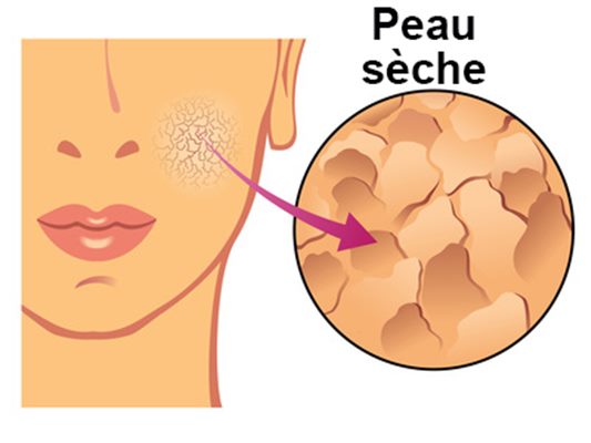 Sécheresse de la peau