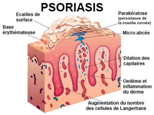 Psoriasis : des réponses à vos questions