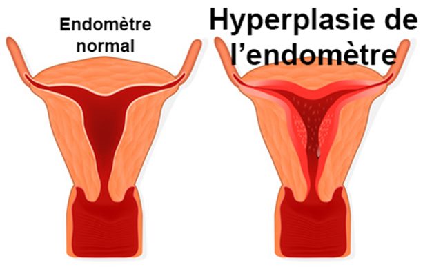 Hyperplasie de l'endomètre