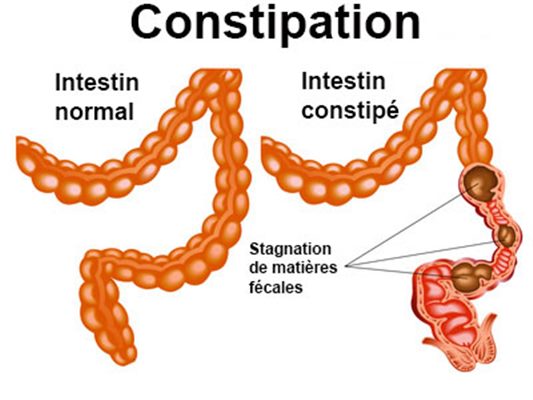 Constipation occasionnelle et laxatifs