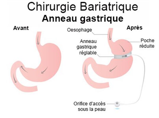 Chirurgie bariatrique